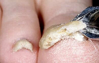 Late fungal nail infection