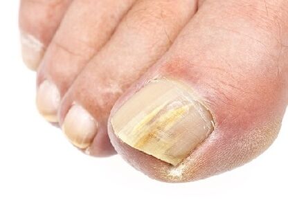The initial stages of nail fungus infection