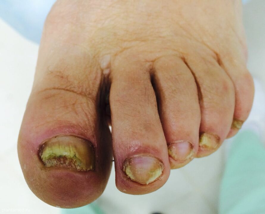 Advanced toenail fungus