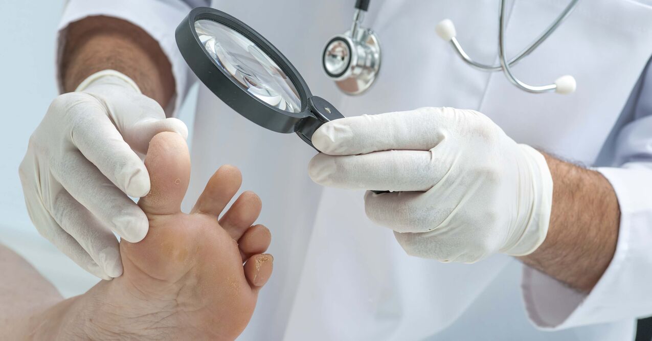 Doctor checks feet for onychomycosis