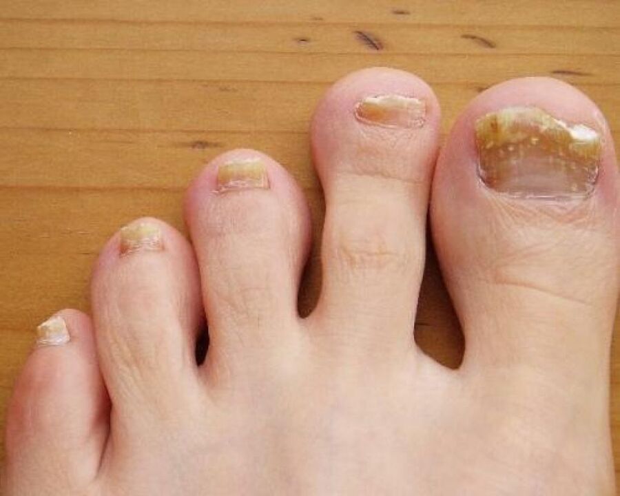 Nail plate turns yellow due to fungus