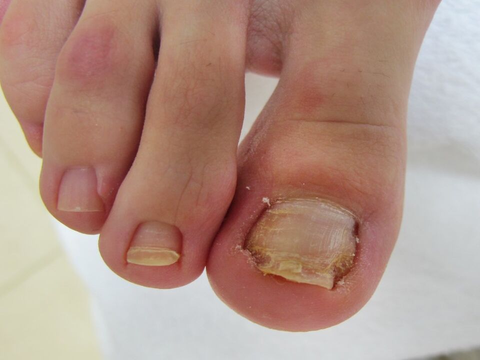 Symptoms of onychomycosis