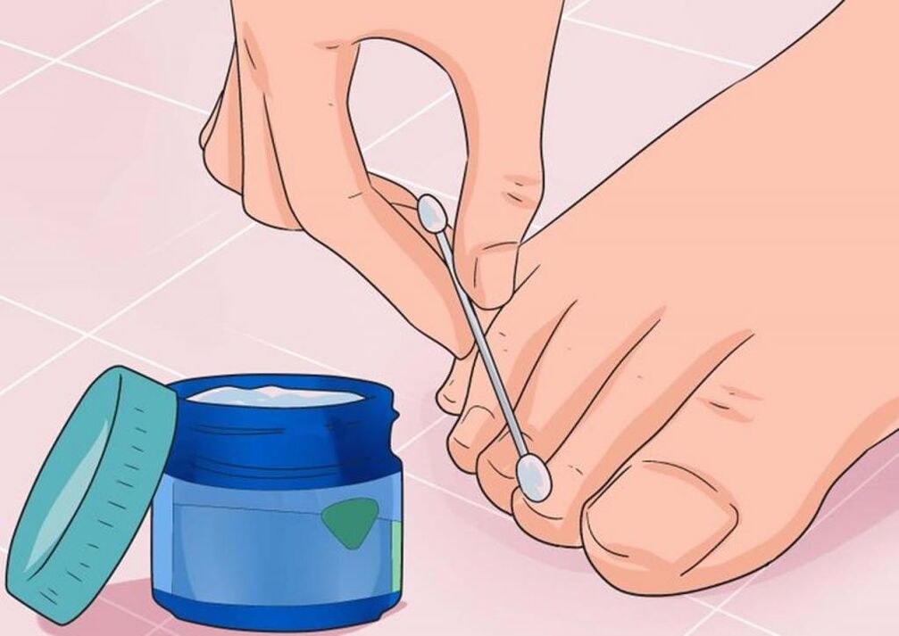 Apply ointment to treat nail fungus