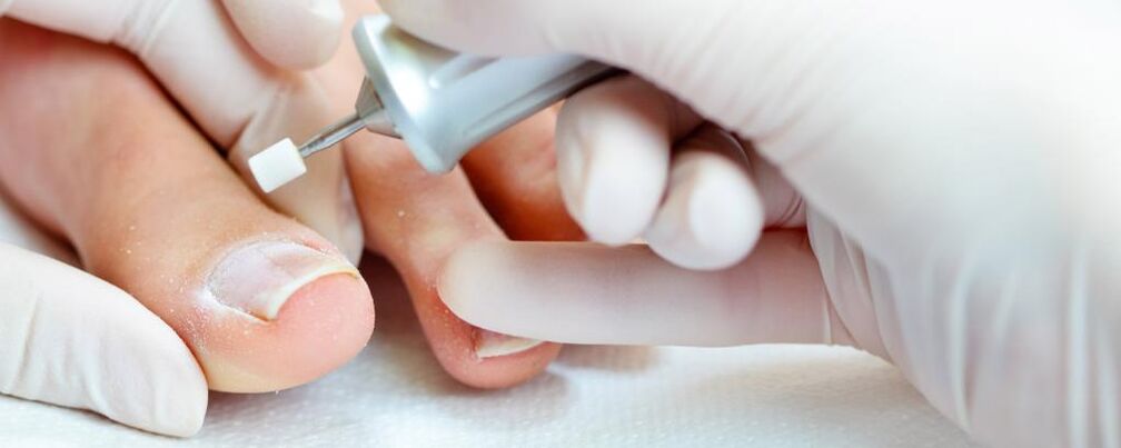 Treatment of big toe fungus manicure