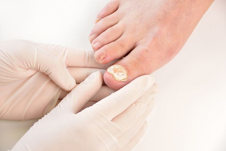Doctors need to diagnose toenail fungus before prescribing it