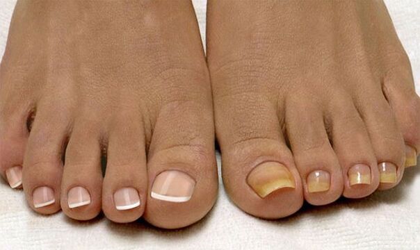 A healthy toenail (left) and a toenail affected by fungus (right)