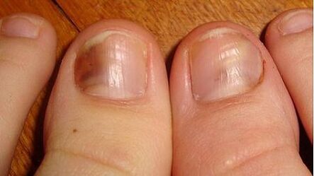A sign of fungal disease is a darkening of the nail plate