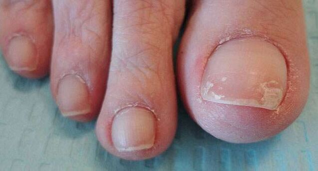 One of the symptoms of onychomycosis is shedding of the nail plate. 