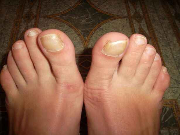Onychomycosis causes thickened toenails