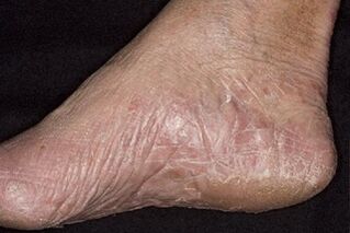 Foot Fungus Symptoms