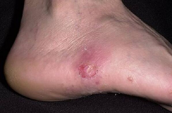 fungus on the skin of the feet