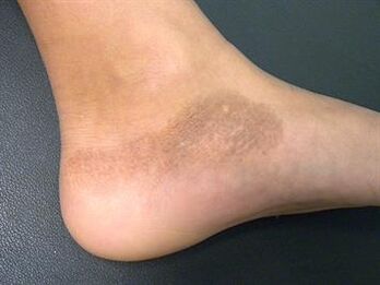 Foot fungus with skin color changes