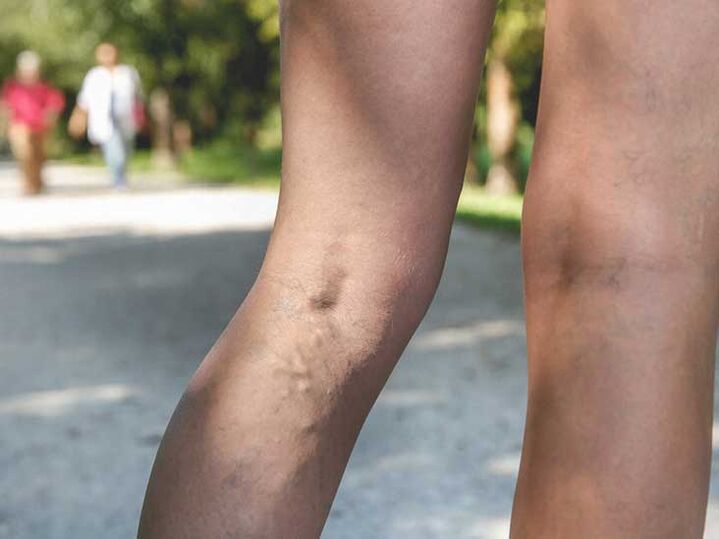 Varicose veins are a risk factor for foot fungal infections