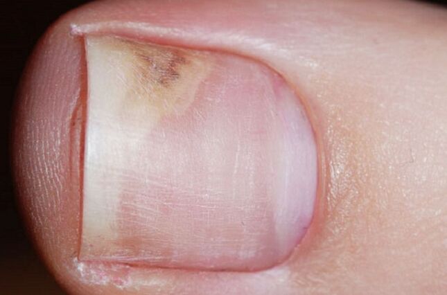 Early symptoms of onychomycosis - lack of shine, gaps between nails and bed
