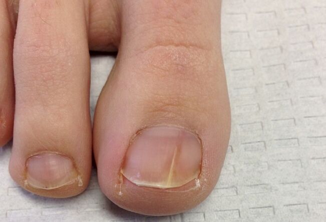 Visual manifestations of early stage onychomycosis