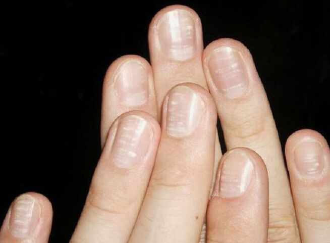 White spots on nails are signs of fungal growth