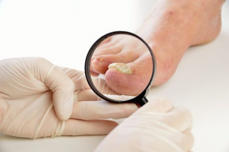 How to Recognize Fungal Disease