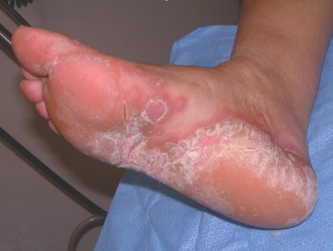 How to Treat Foot Fungus
