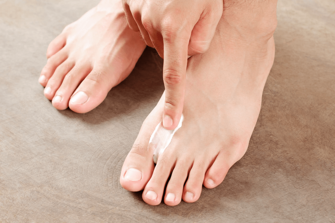 Apply antifungal ointment to the skin of your feet