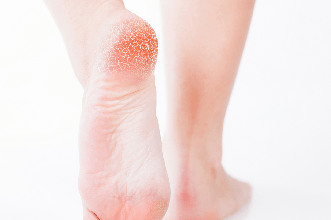 Treatment of early foot fungus