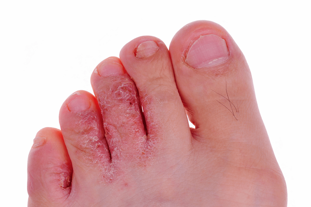fungal skin infection between toes