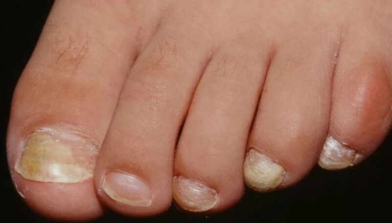 Nail fungus on the thumb
