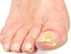 After bathing, affected nails are easier to remove