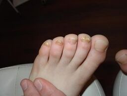 Nail fungi can occur even in children
