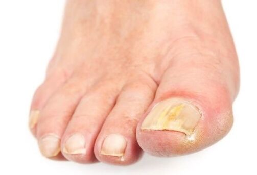 Fungus on nails