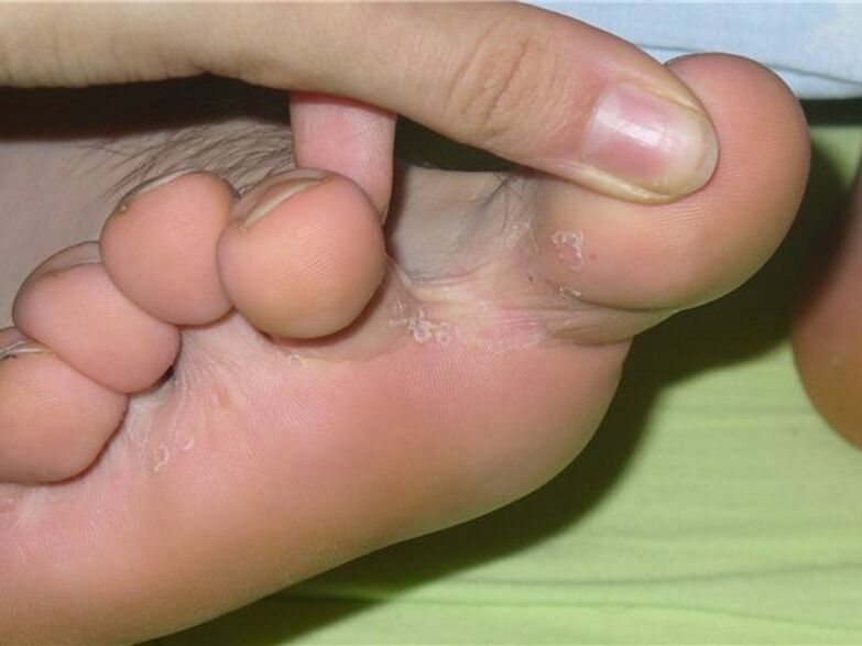 Fungus between fingers