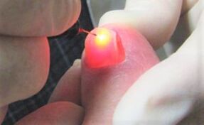 Treat nail fungi with laser