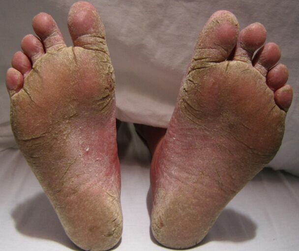 Botox on the feet failed