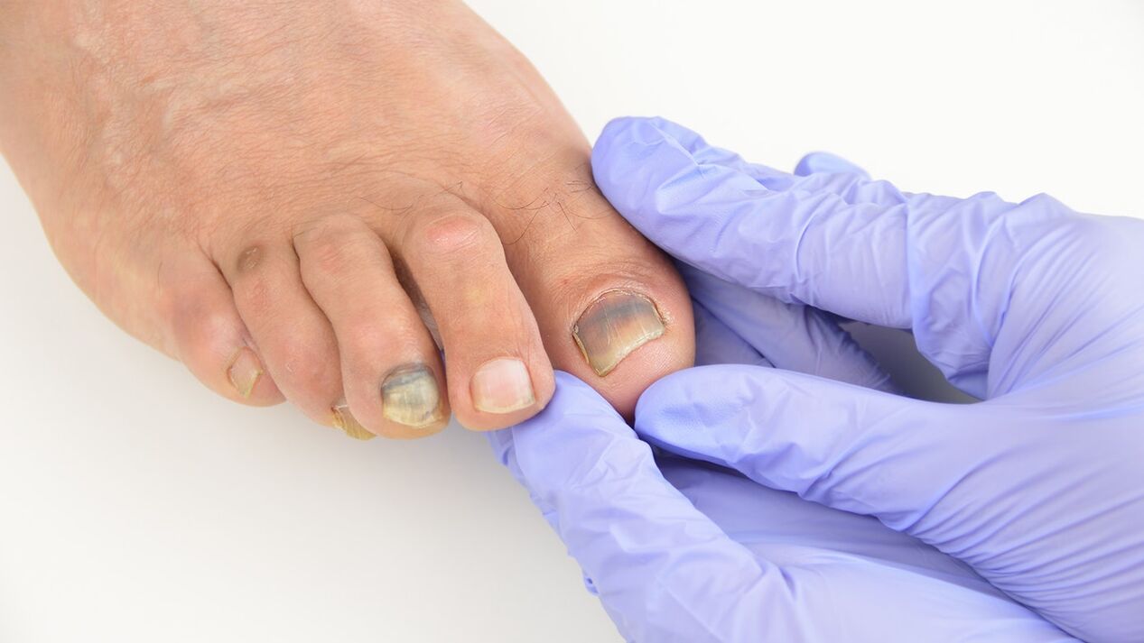 Check for foot fungi