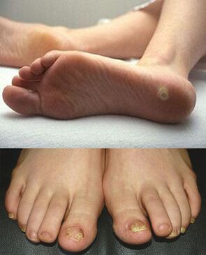 Fungus on the legs
