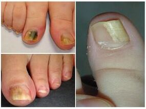 What is the fungus on the nails