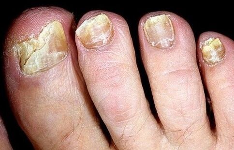 Nails collapse from fungi