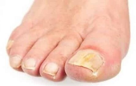 The initial stage of fungi on toenails