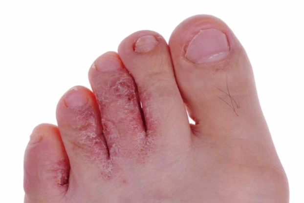 Advanced stages of mycotic disease