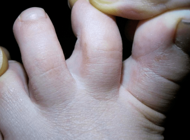 Children's fungal diseases