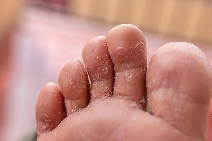 Fungus between fingers