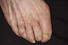 Nail fungus apple cider vinegar on legs