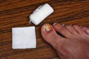 Treatment of compressing fungi with apple cider vinegar