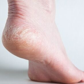 Diagnosis of onychomycosis