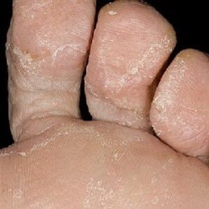 Stages of onychomycosis