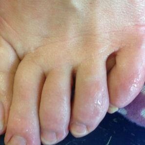 fungal infection route