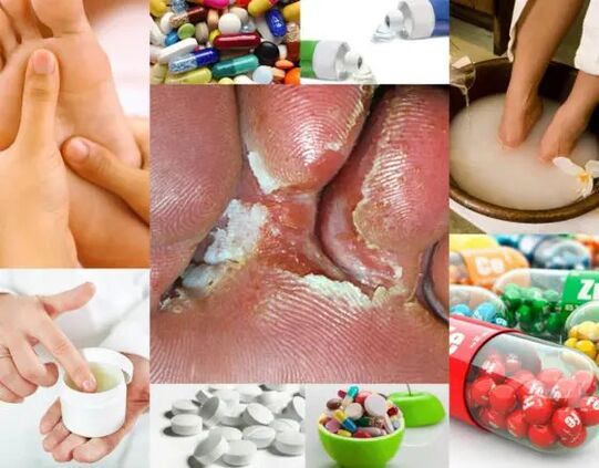 Interdigital fungus and its treatment