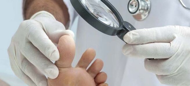 Testing before starting fungal treatment