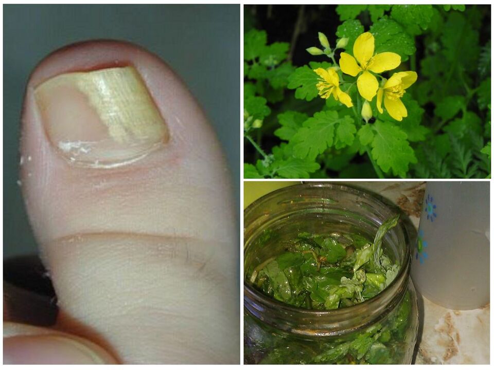 Celandine treats onychomycosis