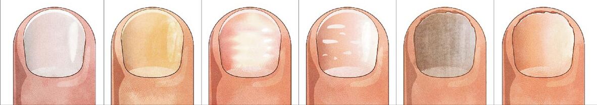 How does onychomycosis form