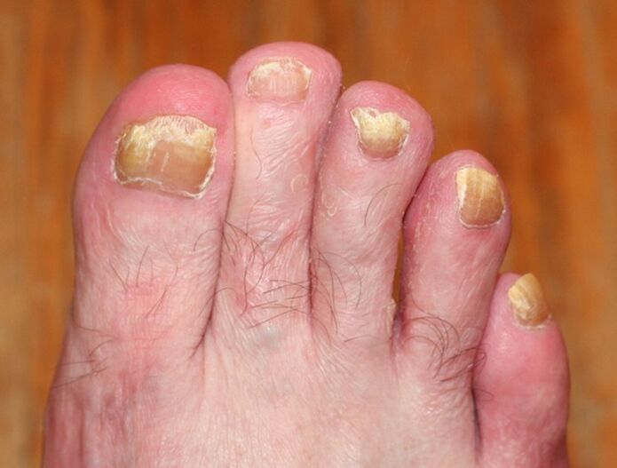 Advanced forms of onychomycosis
